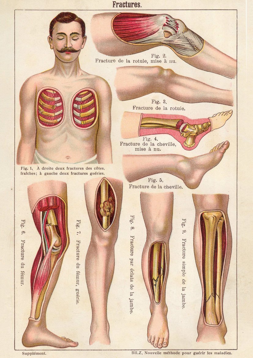 Bone Fracture Medical Chart
